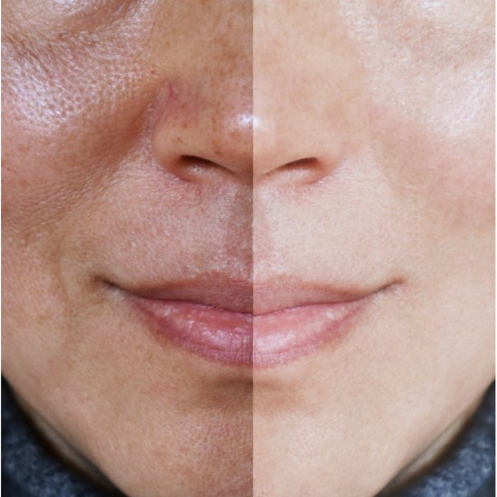 Facial pigmentation treatment cream, melasma and black spots